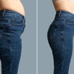 Seitenansicht der Hüftpartie einer Frau in Jeans vor und nach einer Kryolipolyse Behandlung zur Fettreduktion